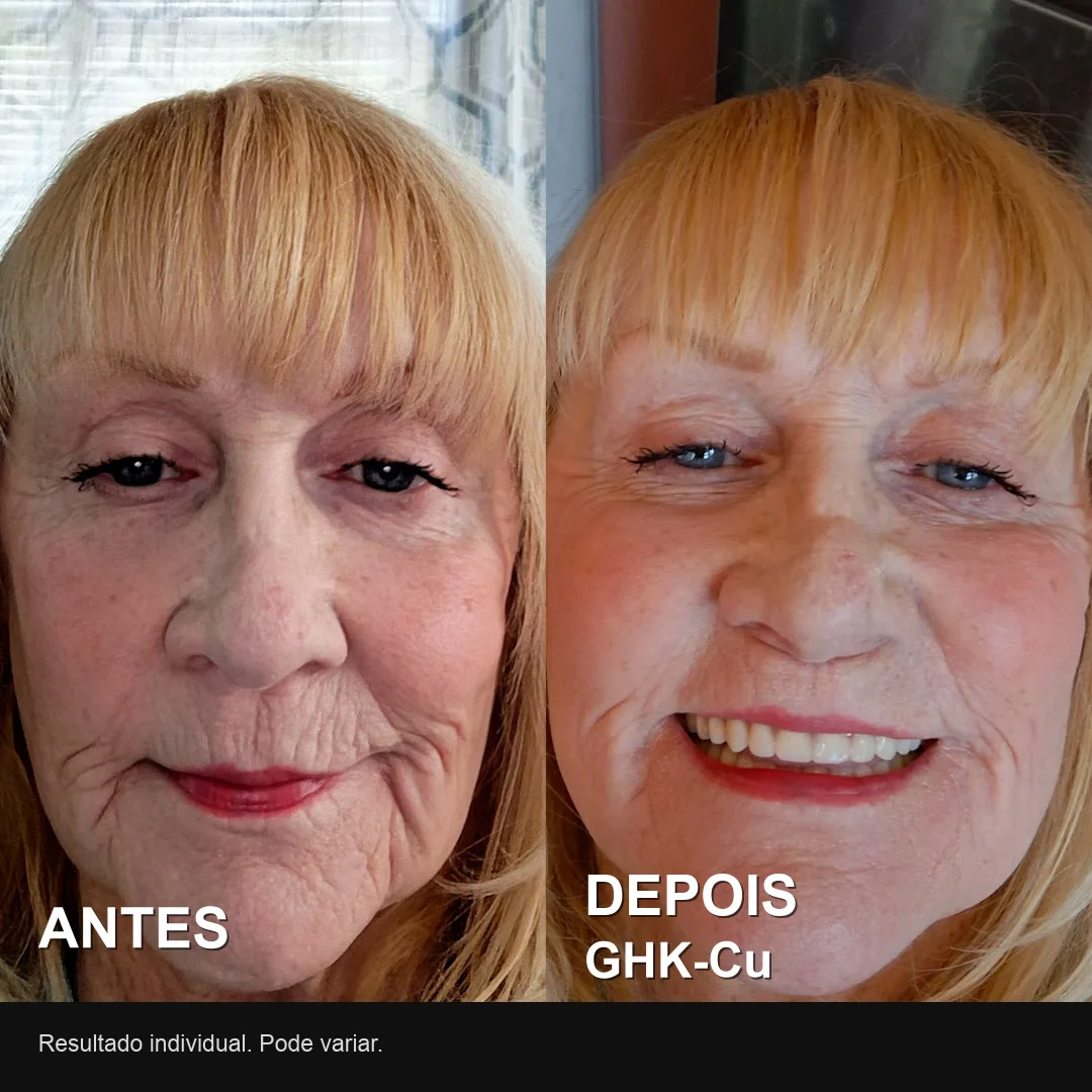 Antes e depois real de usuária do GHK-Cu: menos linhas ao redor da boca
