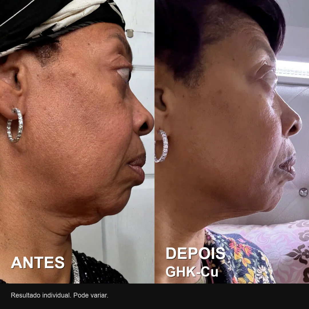 Antes e depois real de usuária do GHK-Cu: contorno de perfil mais firme