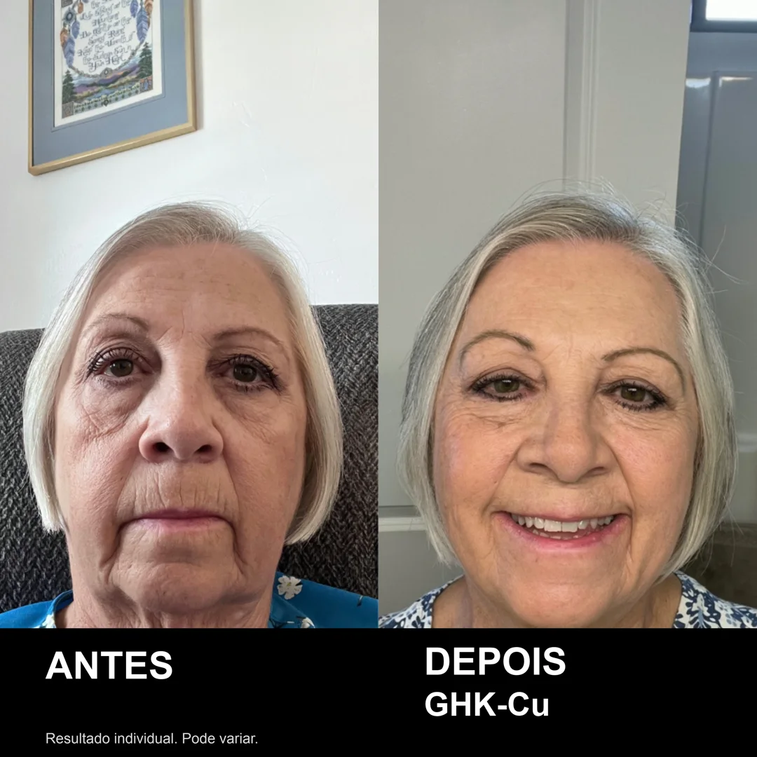 Antes e depois real de usuária do GHK-Cu: rosto mais firme e uniforme