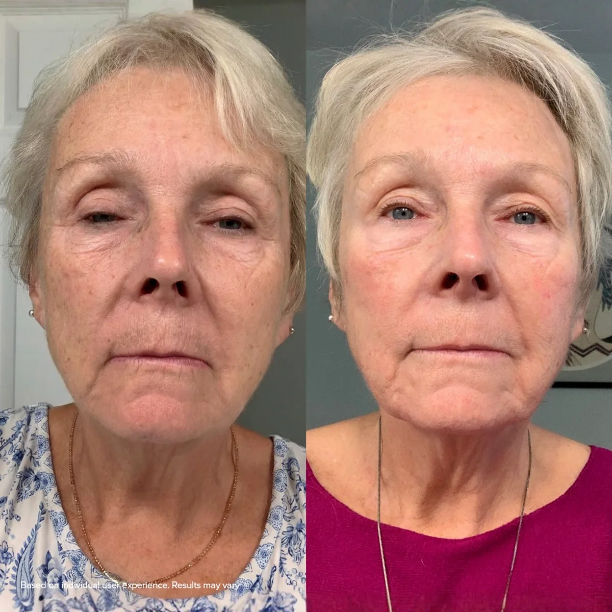 Antes e depois real de usuária: menos manchas e linhas