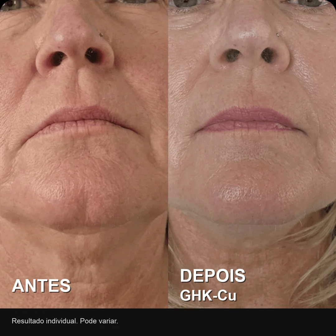 Antes e depois real de usuária do PDRN: textura da pele renovada